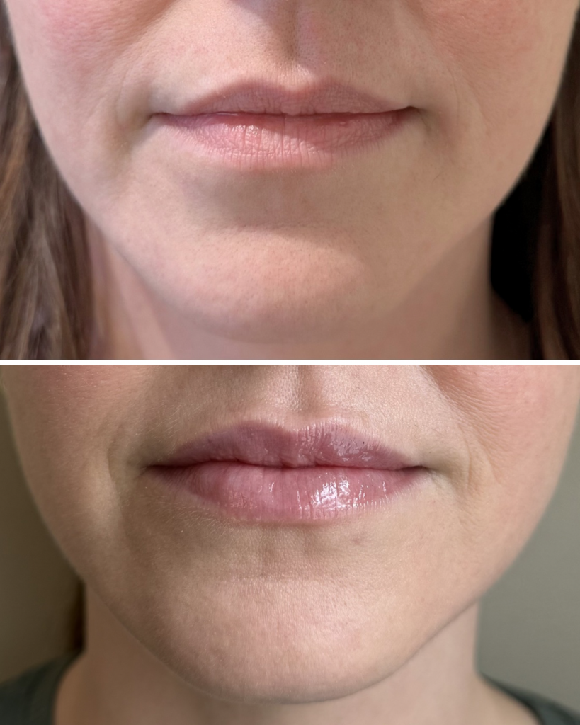 Before and after injectable treatment results