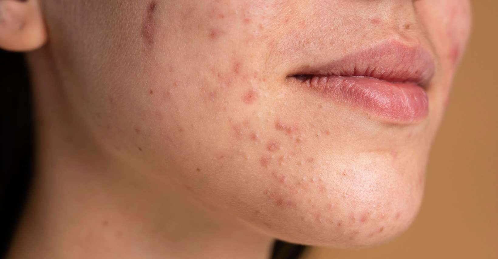 Acne skin correction